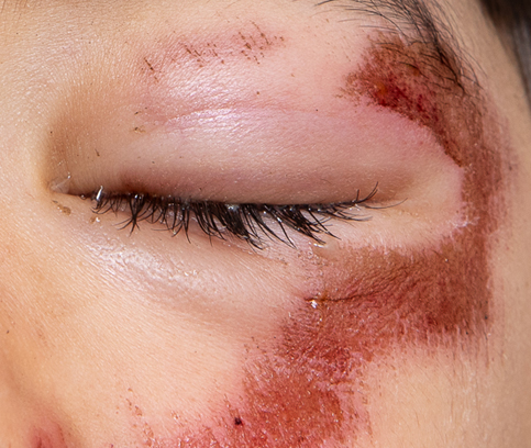 찢어진 눈썹 부위 6개월 후