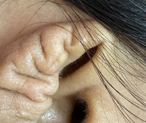 변형된 귀 성형