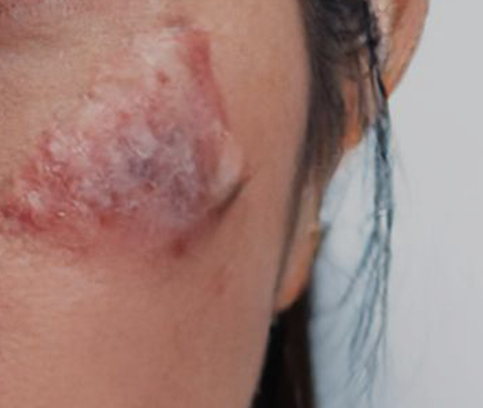 응급실 1차 봉합 후 흉터 교정 케이스..