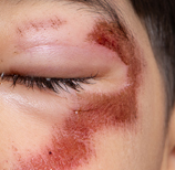 치유앤미 안면 외상