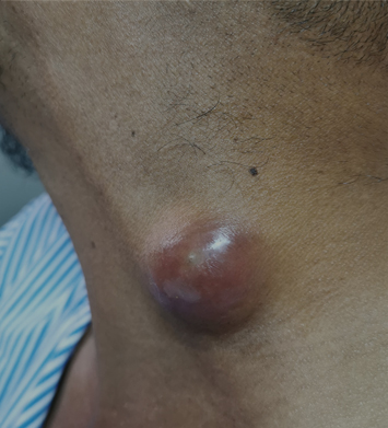 치유앤미 피부(피하) 종양