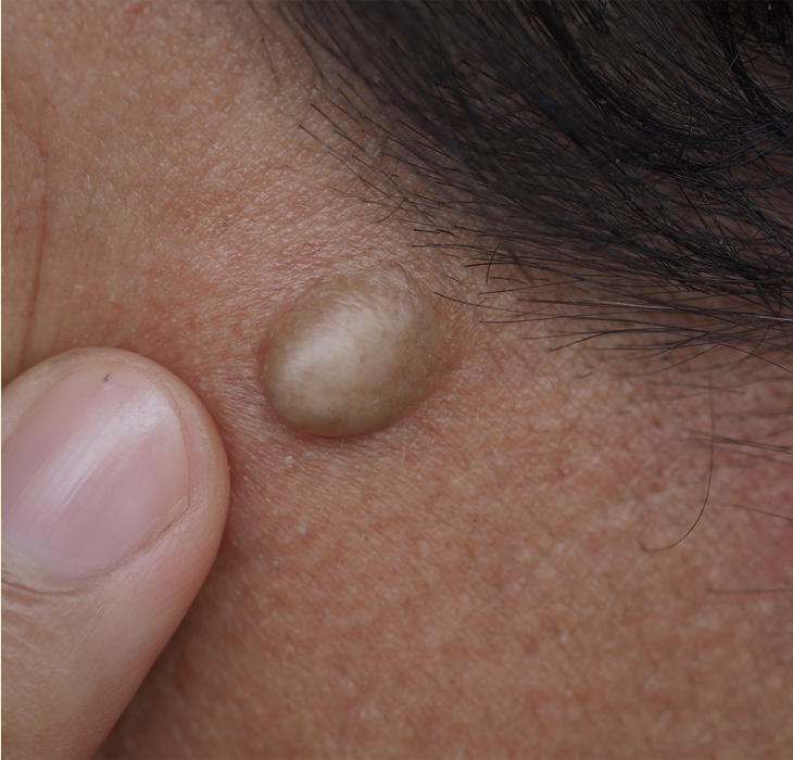 치유앤미 피부(피하) 종양