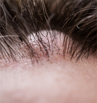 치유앤미 피부(피하) 종양