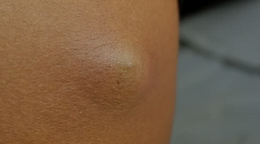 치유앤미 피부(피하) 종양