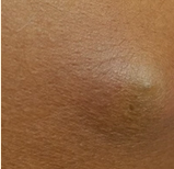 치유앤미 피부(피하) 종양