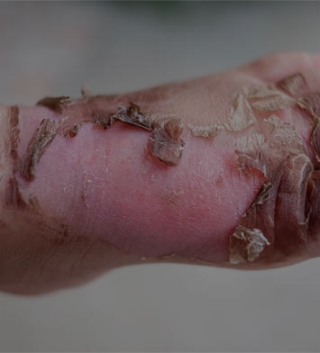 치유앤미 소아 흉터