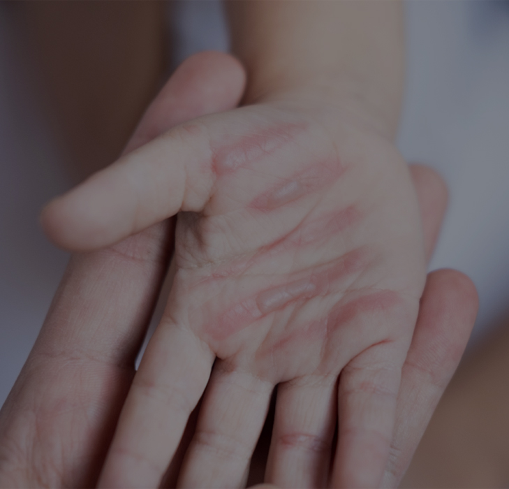 치유앤미 소아 흉터