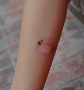 치유앤미 소아 흉터