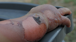 치유앤미 소아 흉터