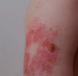 치유앤미 소아 흉터